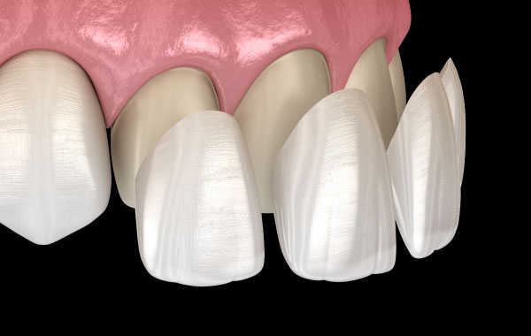 Issaquah Porcelain Veneer Dentist